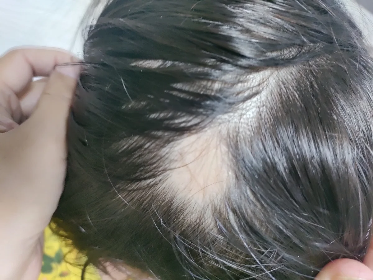 new treatment for alopecia areata new treatment for hair loss